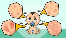【健康科普】让宝宝分分钟“毁容”的不速之客—“湿疹” 到底该怎么办？